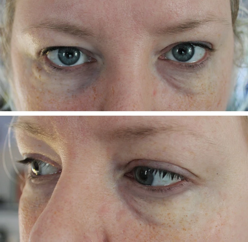 Jess FX - Appliance - Silicone Old Age Eye Bag Prosthetic(Jess Fx Silicone Old Age Eye Bag Prosthetic Appliance) 3 Jess FX - Appliance - Silicone Old Age Eye Bag Prosthetic(Jess Fx Silicone Old Age Eye Bag Prosthetic Appliance)