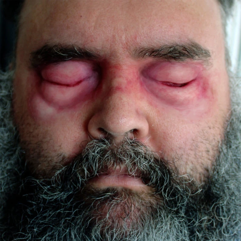 Jess FX - Appliance - Silicone Swollen Shut Eye Prosthetic(Jess Fx Silicone Swollen Shut Eye Prosthetic Appliance) 3 Jess FX - Appliance - Silicone Swollen Shut Eye Prosthetic(Jess Fx Silicone Swollen Shut Eye Prosthetic Appliance)